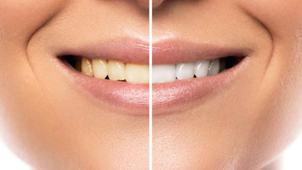 qual a diferença entre clareamento e limpeza de dentes